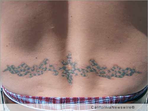 Laser Tattoo Removal  Skinpeccable